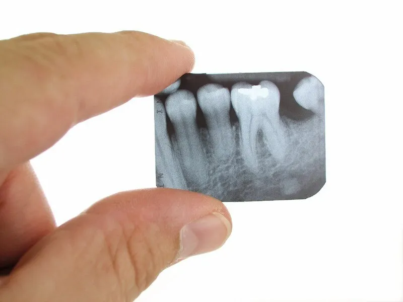 A dental X-ray at Queen City Dental.